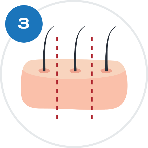 GRAFTS
DISSECTION